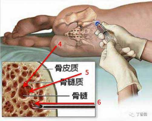 骨穿过程视频（骨穿操作步骤视频教程）-图3