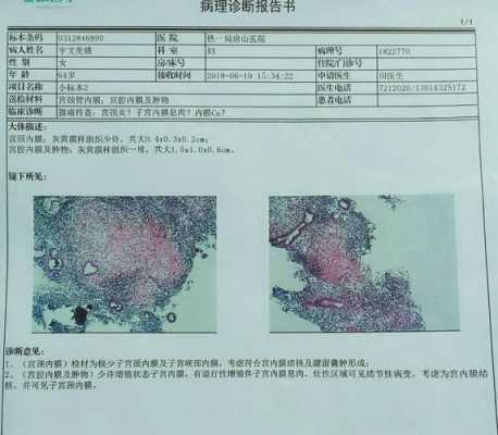 子宫内膜活检过程图片（子宫内膜活检要几天出结果）-图1