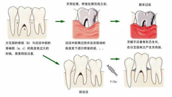 牙根的发育过程（牙根发育过程中,由哪几部分构成根端复合体）-图2