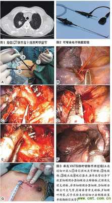 肺癌手术过程图片（肺癌手术操作流程）-图1