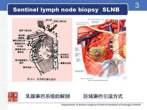 前哨淋巴清扫过程（什么叫前哨淋巴清扫是什么意思）-图1