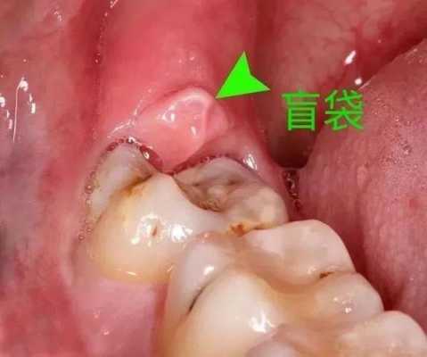 拔智齿疼的过程（拔智齿疼的过程视频播放）-图3