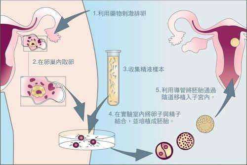 试管婴儿移植过程图（试管婴儿移植图片 着床）-图1