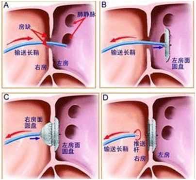 室间隔封堵过程（室间隔封堵术后预期寿命）-图1