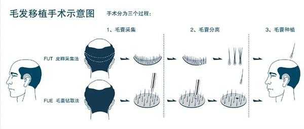 毛发移植过程（毛发移植术标准操作步骤）-图2