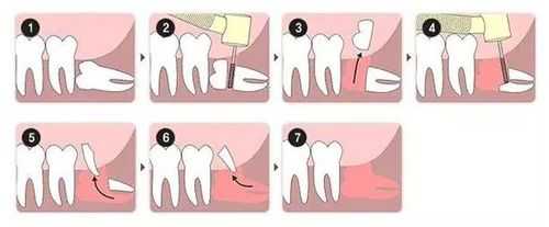 拔智齿的过程图解（拔智齿演示图）-图2