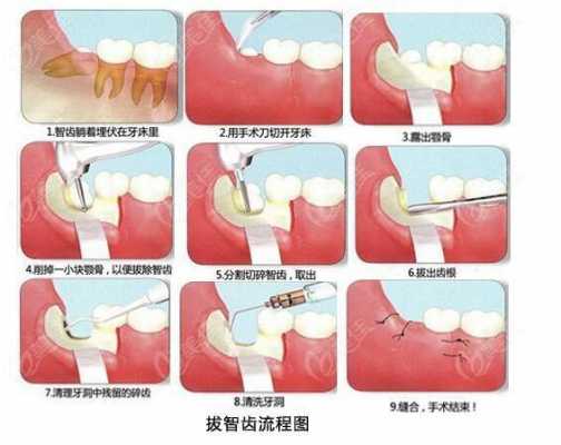 拔智齿的过程图解（拔智齿演示图）-图3