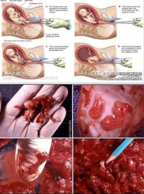 做打胎过程（打胎的操作流程）-图1