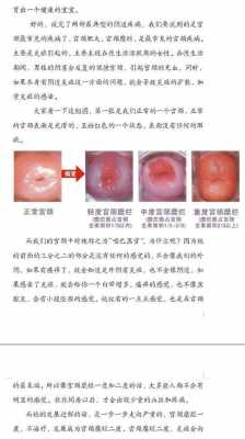 宫颈糜烂物理治疗过程（宫颈糜烂物理治疗过程图）-图3