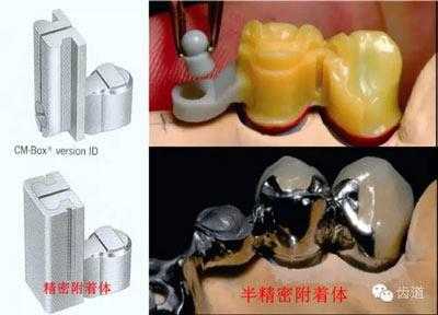 精密附着体制作过程（精密附着体制作过程视频）-图2