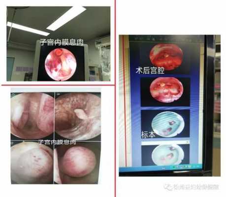 宫腔镜电切息肉过程（宫腔镜电切术息肉住院几天）-图1