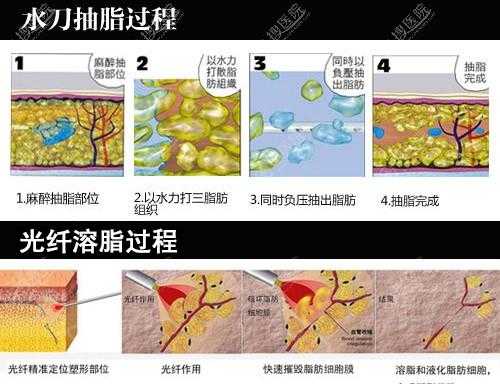 光迁溶脂的过程（光热溶脂）-图1