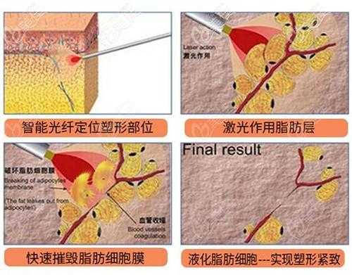 光迁溶脂的过程（光热溶脂）-图3