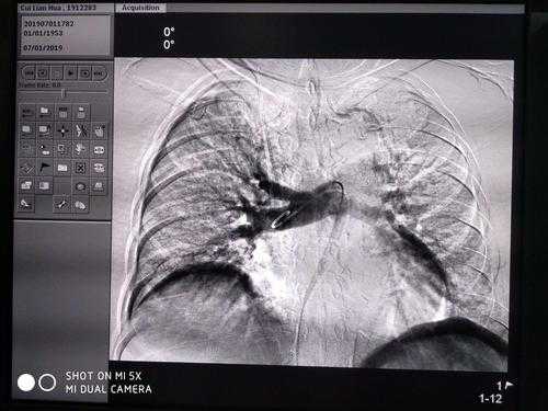 肺栓塞手术过程（肺栓塞的手术）-图2