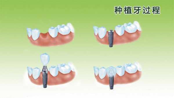 深圳种植牙过程图片（深圳种植牙多少钱一颗2020）-图3