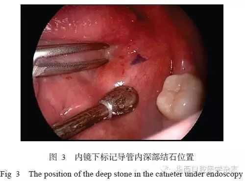 颌下腺结石手术过程（颌下腺结石手术要多久）-图3