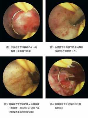 宫腔镜电切术过程（宫腔镜电切操作步骤）-图1