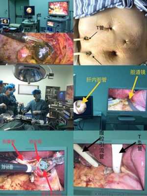 切除胆囊手术的过程（胆囊切除术手术过程）-图1