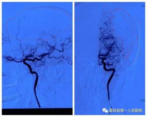 烟雾病手术过程（烟雾病手术风险大不大?）-图2