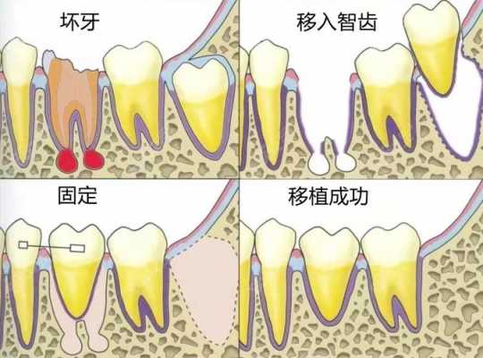 牙移植过程（牙移植术步骤）-图3