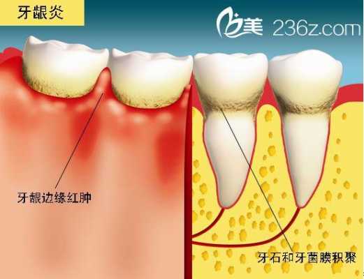 牙龈乳头炎的治疗过程（牙龈乳头炎的治疗方法）-图2