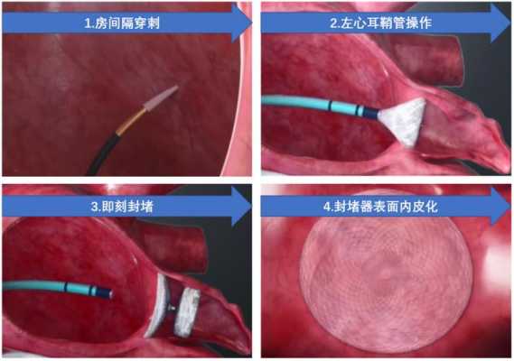 左心耳封堵术过程（左心耳封堵术的过程）-图1