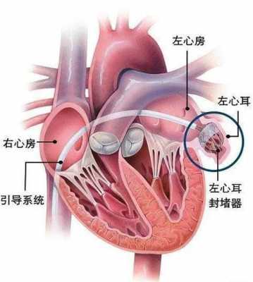 左心耳封堵术过程（左心耳封堵术的过程）-图3