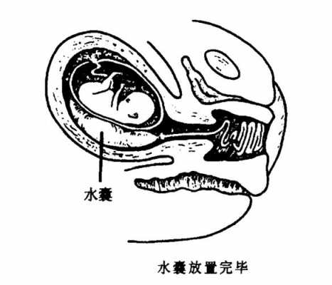 水囊引产过程视频（水囊引产视频操作）-图2