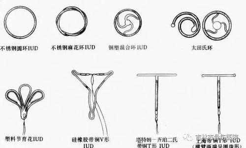 节孕环放置过程视频（节孕环干什么用的）-图3