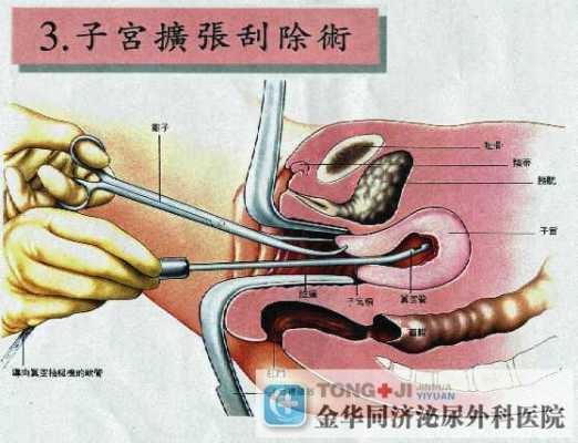 模拟药流过程（药流操作）-图3