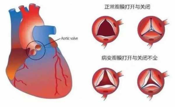 换心脏瓣膜过程（换心脏瓣膜的风险大吗）-图3