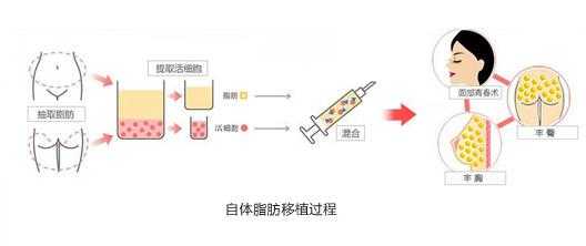 自体脂肪移植过程（自体脂肪移植手术风险）-图1