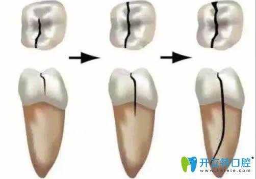 牙隐裂的治疗过程（牙隐裂治疗过程中会裂吗）-图2