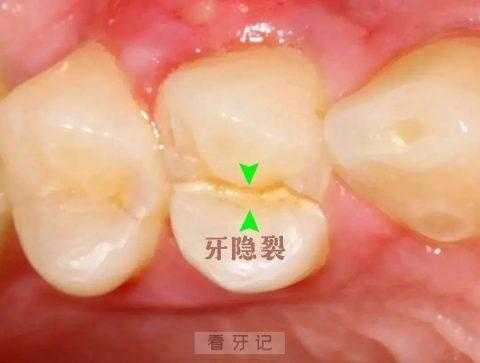 牙隐裂的治疗过程（牙隐裂治疗过程中会裂吗）-图3