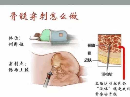 新生儿骨髓穿刺术过程（婴儿骨髓穿刺对身体的危害有多大）-图1