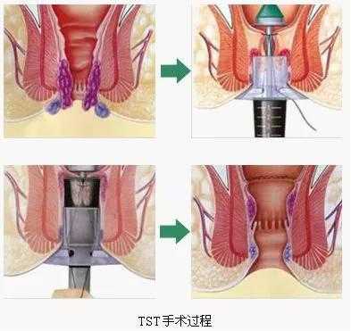 微创的痔疮手术过程（微创痔疮手术过程多长时间）-图2