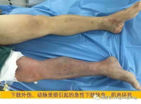 肌肉缺血坏死的过程（肌肉缺血多久出现不可逆损伤）-图1