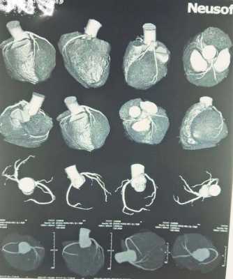 做冠脉ct的过程（做冠脉ct的过程中中间造影剂分几次打进身体）-图1