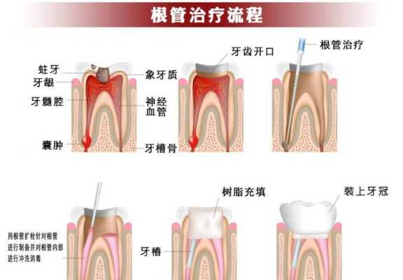 根管治疗过程图片（根管治疗流程图）-图3