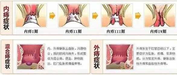 痔疮痊愈过程（痔疮的恢复期要多久）-图1