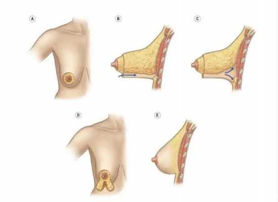 乳房包块手术过程（乳房包块做手术需要多长时间）-图2