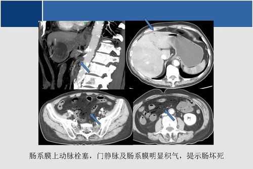 小肠cte过程（小肠cte检查方法）-图3