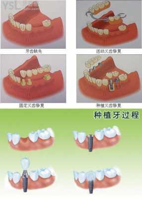 装假牙的过程说说（装假牙的过程说说文案）-图1