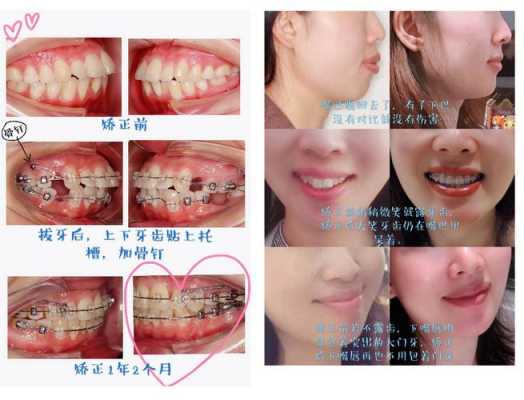 矫正牙齿哪个过程最疼（矫正牙齿最疼的是哪个阶段）-图1