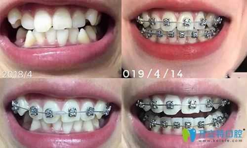 矫正牙齿哪个过程最疼（矫正牙齿最疼的是哪个阶段）-图2