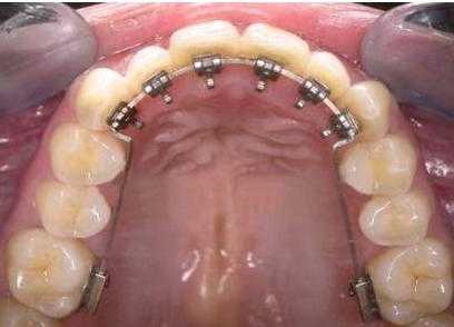 矫正牙齿哪个过程最疼（矫正牙齿最疼的是哪个阶段）-图3
