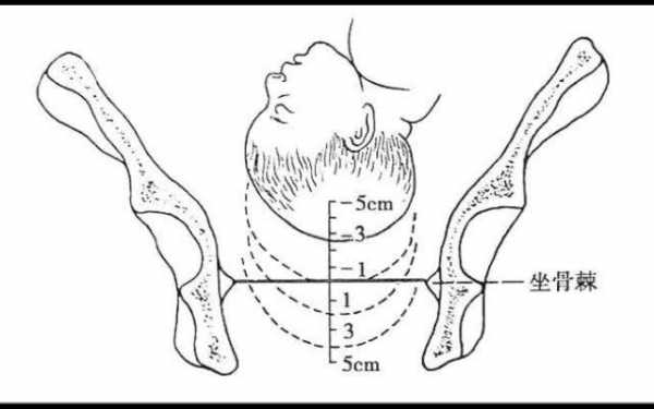 胎头下降过程（胎头下降程度的标志）-图2