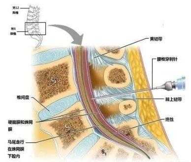 腰麻过程疼不疼（腰麻到底有多疼）-图2