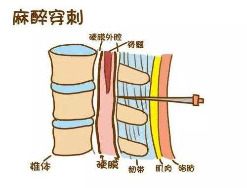 腰麻过程疼不疼（腰麻到底有多疼）-图3