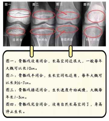 骨骼收缩的过程（骨骼收缩了还能长高吗）-图2